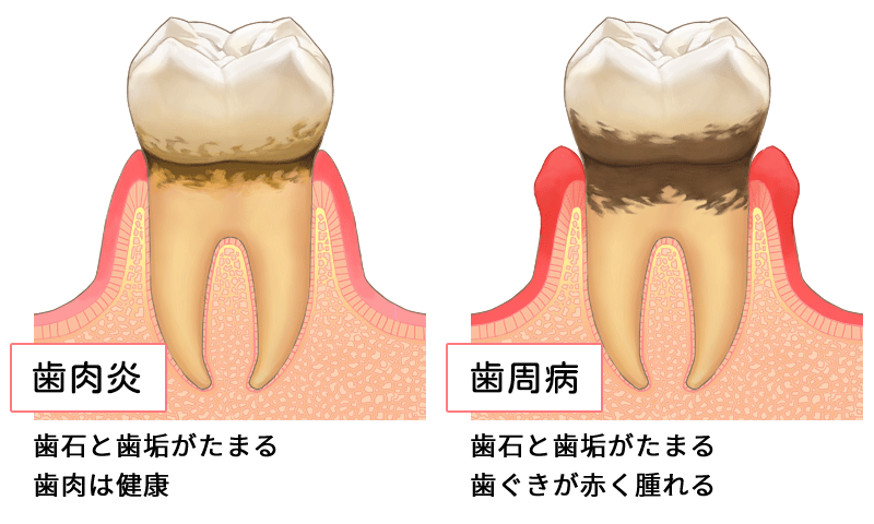 歯周病の進行イメージ